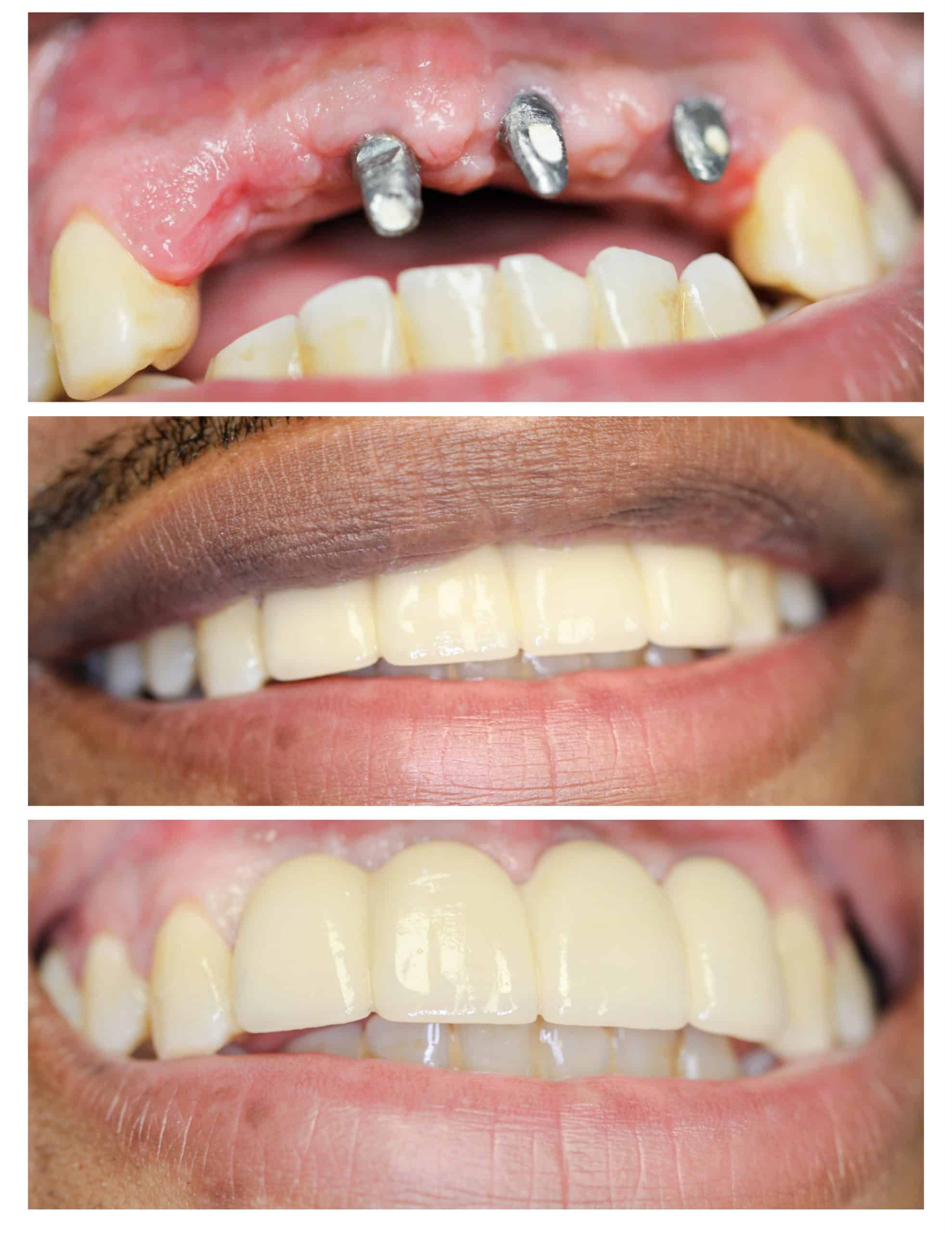 Implant Crown Result Dwarka Dentist