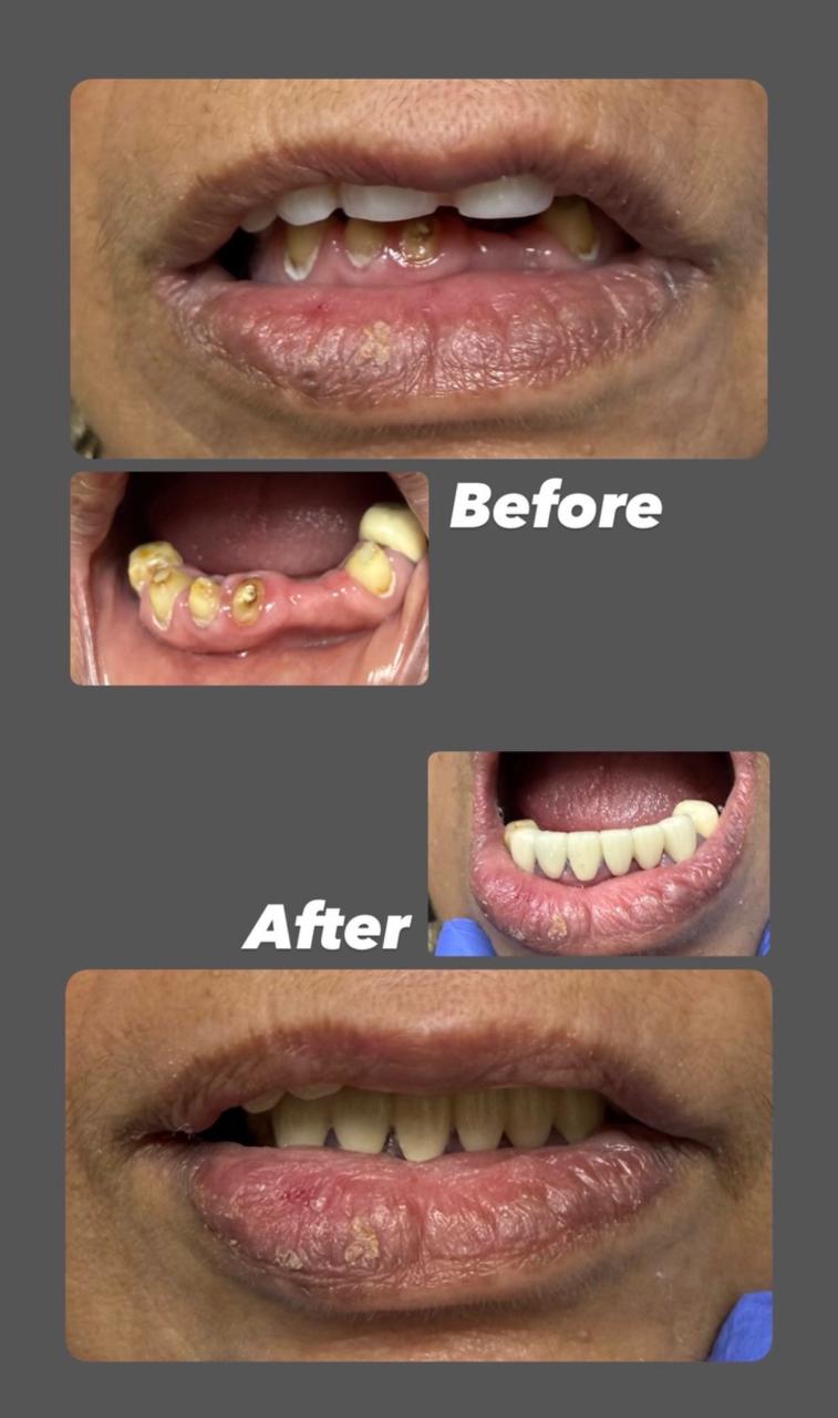 Dental Implant Result Dwarka Delhi