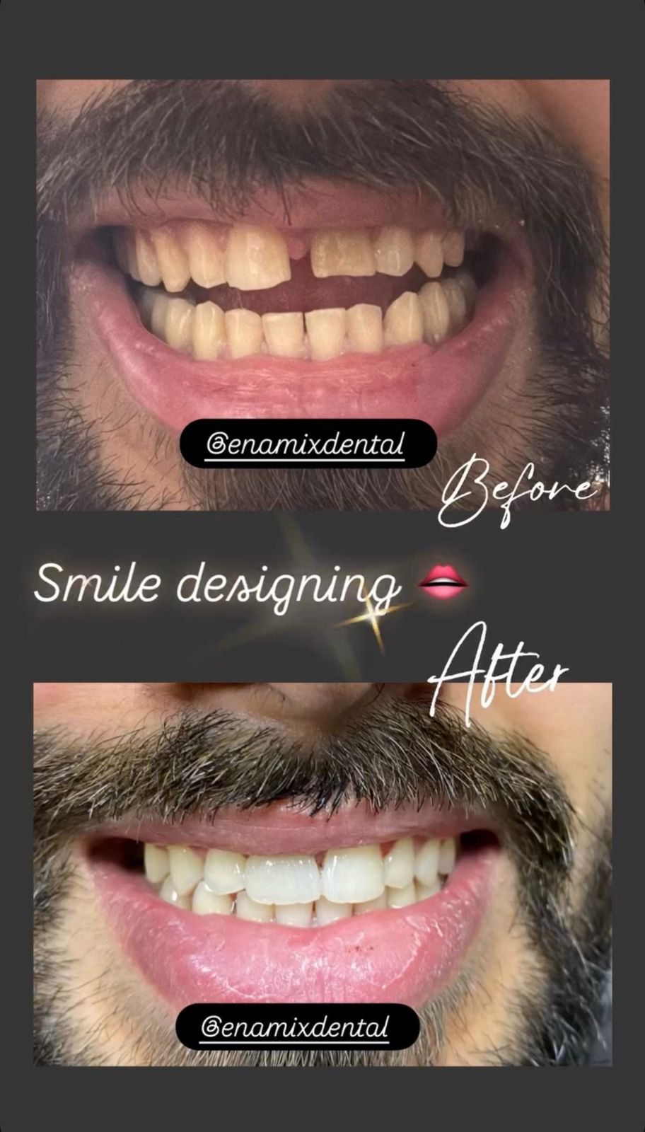Happy Patient Smile Result Enamix Dental