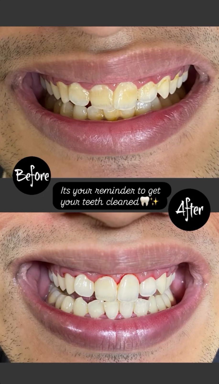 Teeth Whitening Before After Dwarka Delhi