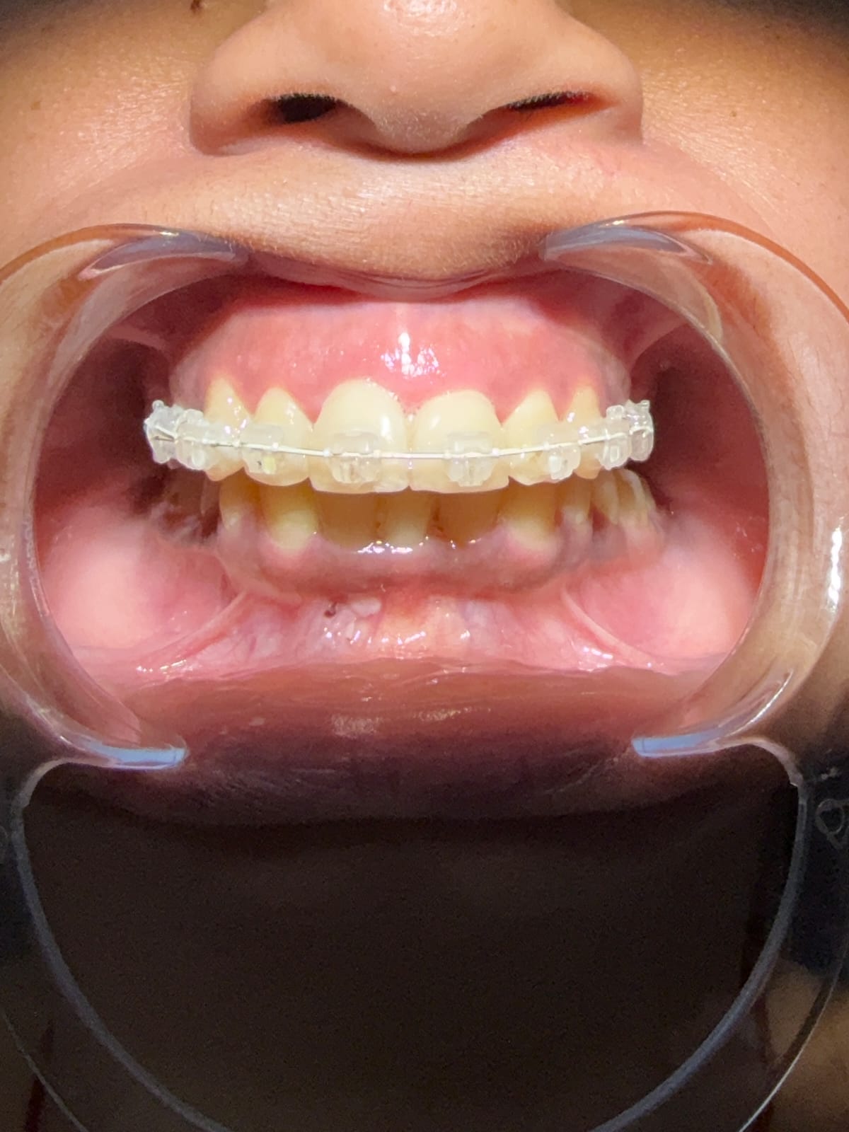 Braces Treatment Result Dwarka Delhi